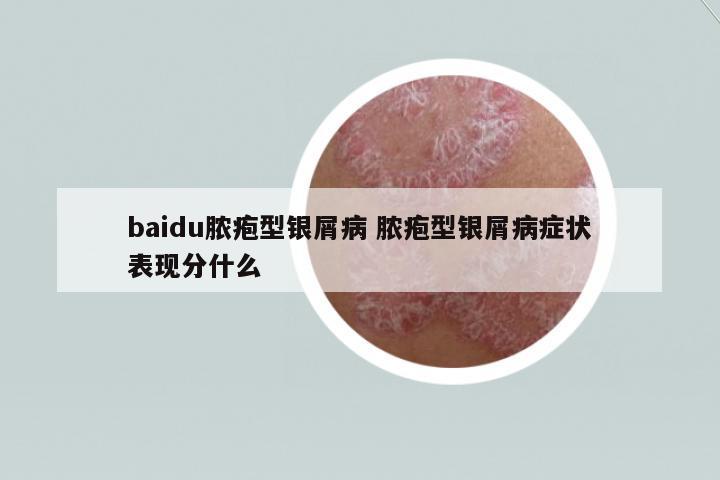 baidu膿皰型銀屑病 膿皰型銀屑病癥狀表現(xiàn)分什么