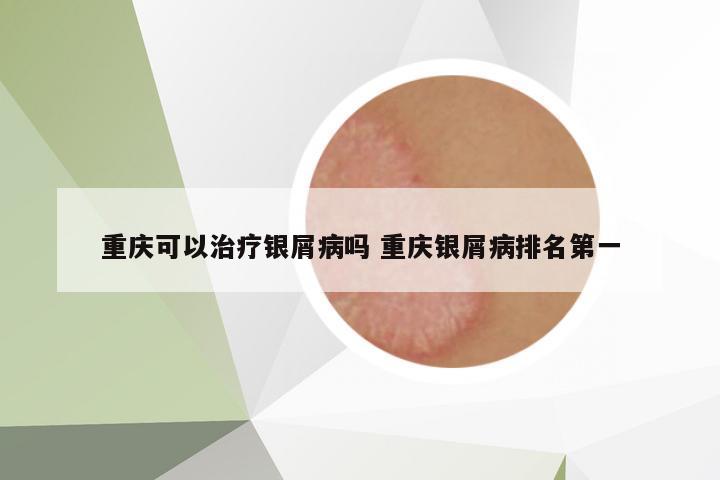 重慶可以治療銀屑病嗎 重慶銀屑病排名第一