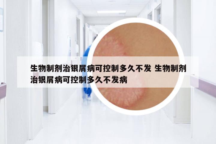 生物制劑治銀屑病可控制多久不發(fā) 生物制劑治銀屑病可控制多久不發(fā)病
