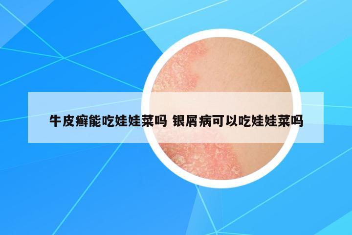 牛皮癬能吃娃娃菜嗎 銀屑病可以吃娃娃菜嗎