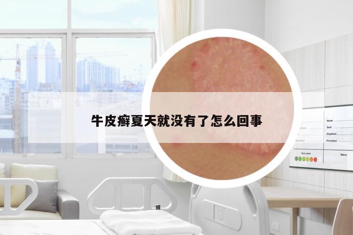 牛皮癬夏天就沒(méi)有了怎么回事