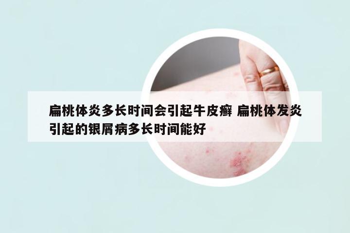 扁桃體炎多長時間會引起牛皮癬 扁桃體發(fā)炎引起的銀屑病多長時間能好