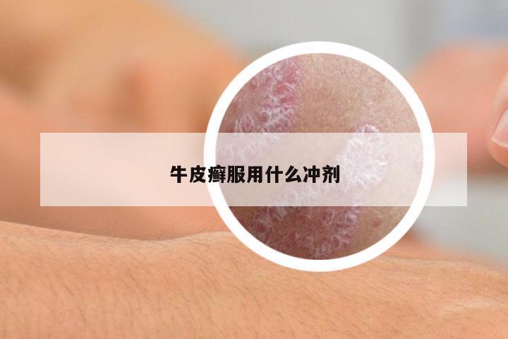 牛皮癬服用什么沖劑