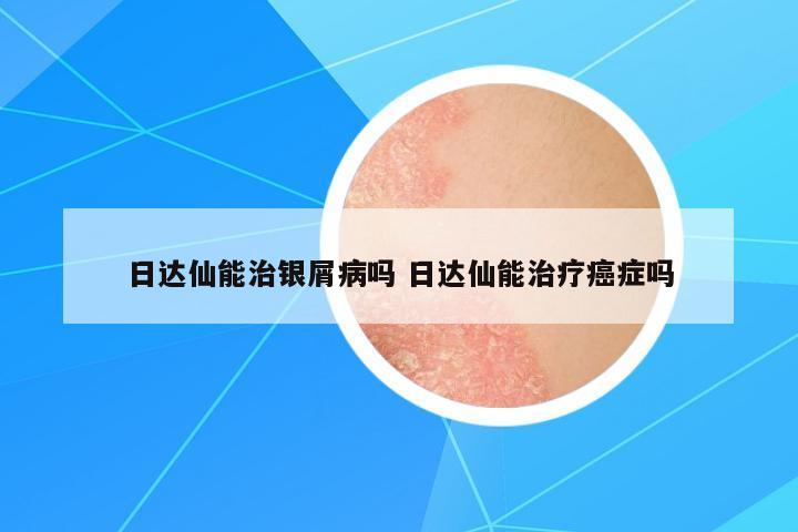 日達仙能治銀屑病嗎 日達仙能治療癌癥嗎