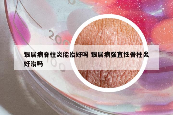銀屑病脊柱炎能治好嗎 銀屑病強(qiáng)直性脊柱炎好治嗎
