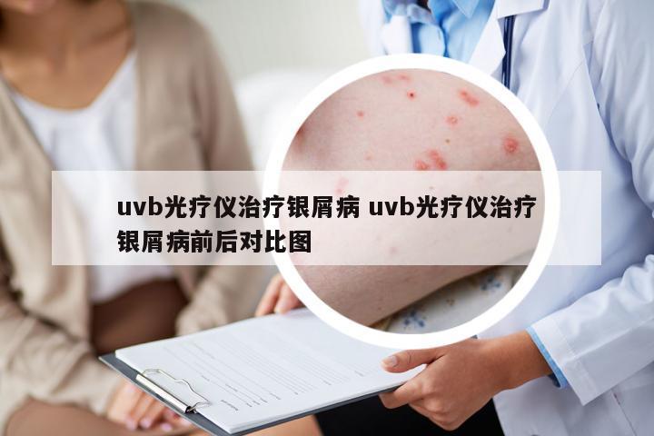 uvb光療儀治療銀屑病 uvb光療儀治療銀屑病前后對比圖