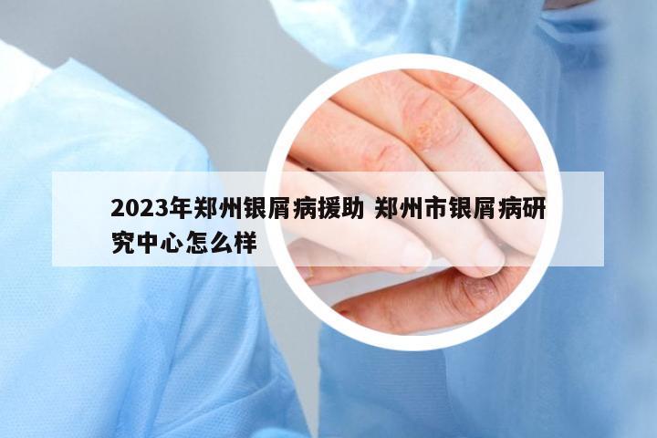 2023年鄭州銀屑病援助 鄭州市銀屑病研究中心怎么樣