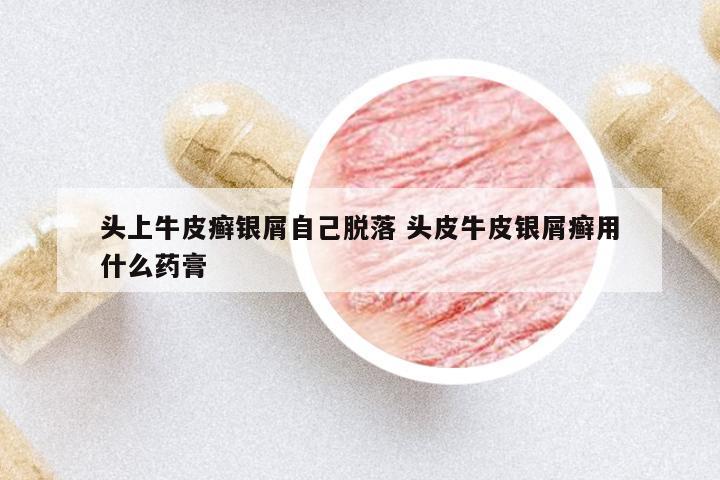 頭上牛皮癬銀屑自己脫落 頭皮牛皮銀屑癬用什么藥膏