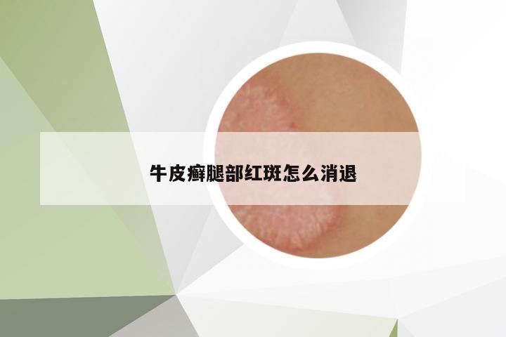 牛皮癬腿部紅斑怎么消退