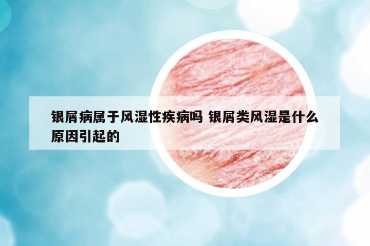 銀屑病屬于風濕性疾病嗎 銀屑類風濕是什么原因引起的