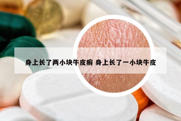 身上長(zhǎng)了兩小塊牛皮癬 身上長(zhǎng)了一小塊牛皮