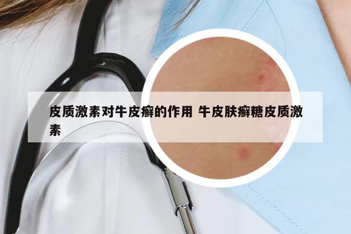 皮質(zhì)激素對(duì)牛皮癬的作用 牛皮膚癬糖皮質(zhì)激素