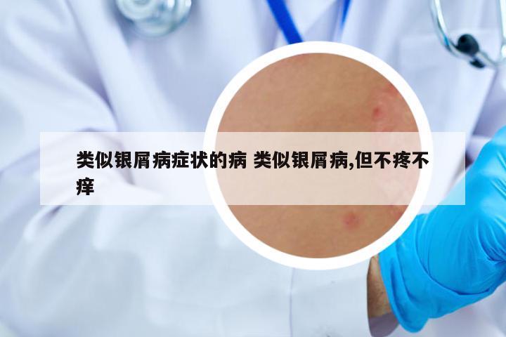 類似銀屑病癥狀的病 類似銀屑病,但不疼不癢