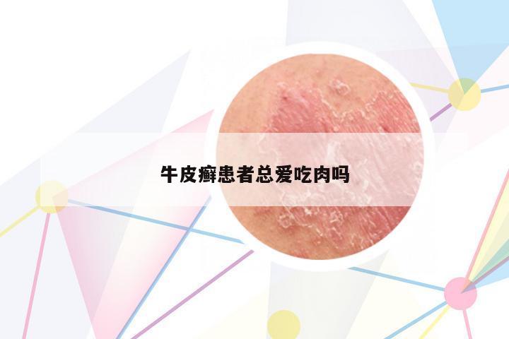 牛皮癬患者總愛吃肉嗎