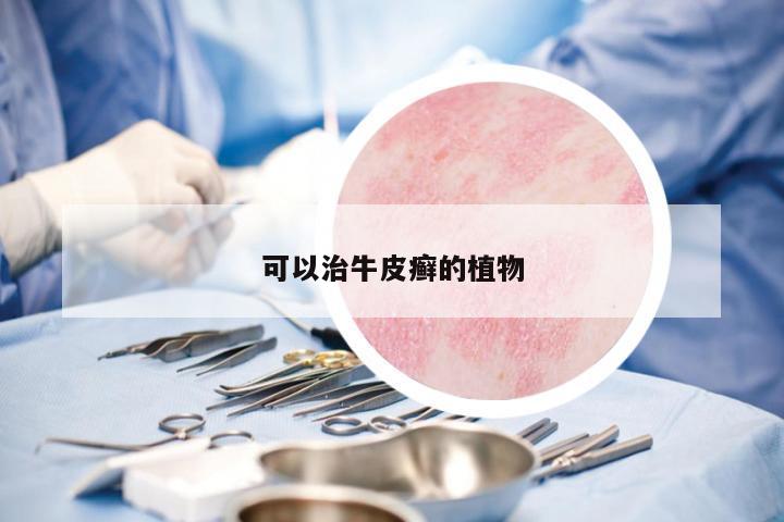 可以治牛皮癬的植物