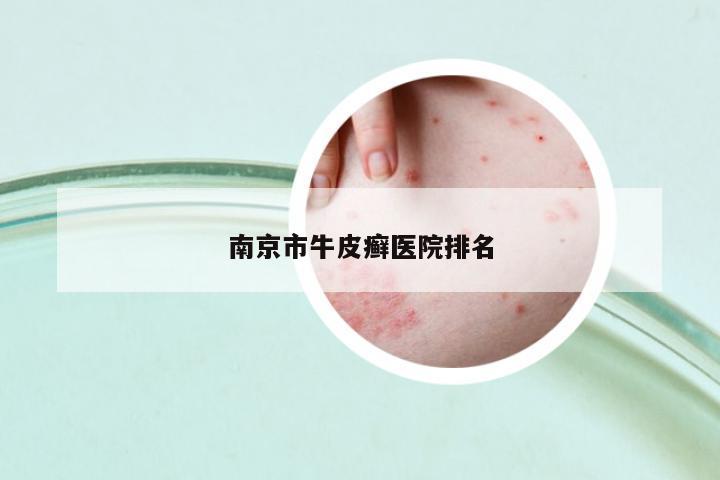 南京市牛皮癬醫(yī)院排名