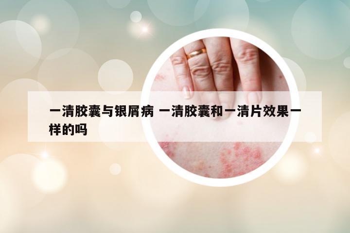 一清膠囊與銀屑病 一清膠囊和一清片效果一樣的嗎