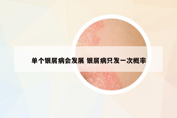 單個(gè)銀屑病會(huì)發(fā)展 銀屑病只發(fā)一次概率