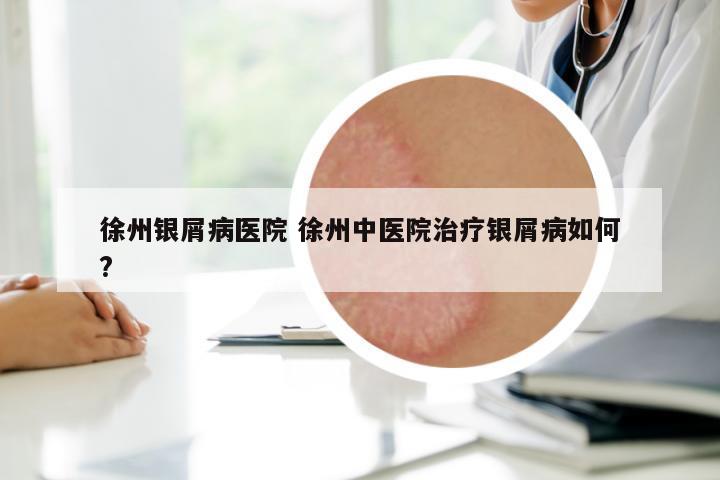 徐州銀屑病醫(yī)院 徐州中醫(yī)院治療銀屑病如何?