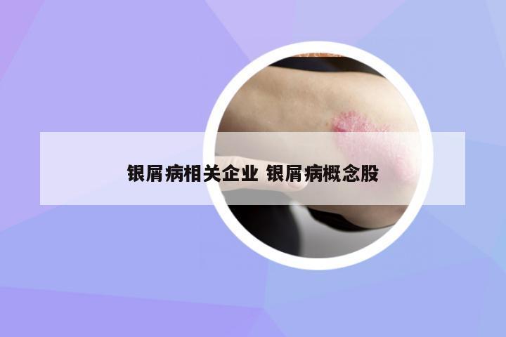 銀屑病相關(guān)企業(yè) 銀屑病概念股