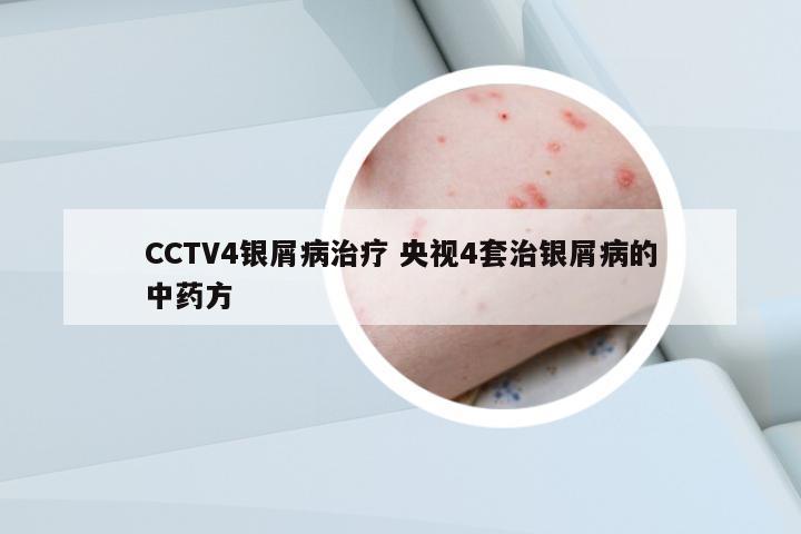 CCTV4銀屑病治療 央視4套治銀屑病的中藥方
