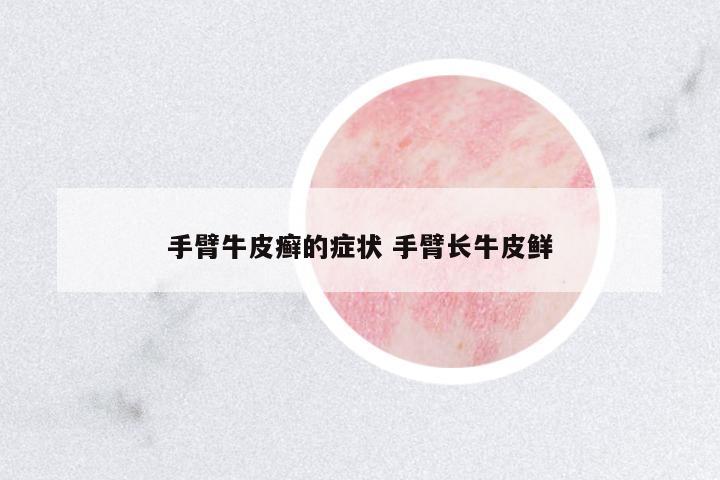 手臂牛皮癬的癥狀 手臂長牛皮鮮