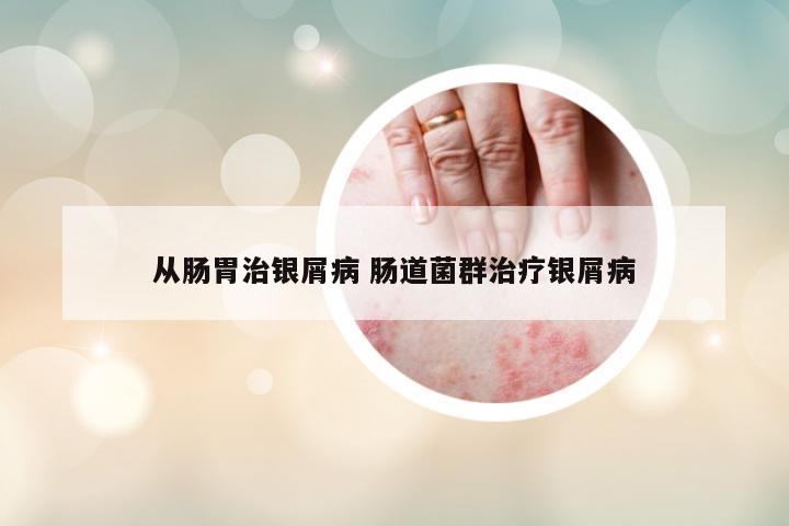 從腸胃治銀屑病 腸道菌群治療銀屑病