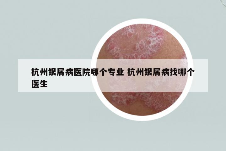 杭州銀屑病醫(yī)院哪個專業(yè) 杭州銀屑病找哪個醫(yī)生