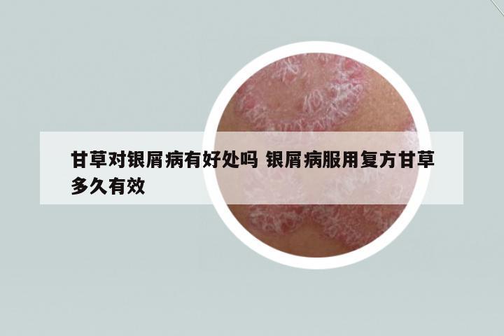 甘草對銀屑病有好處嗎 銀屑病服用復(fù)方甘草多久有效