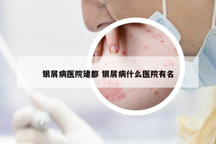 銀屑病醫(yī)院建都 銀屑病什么醫(yī)院有名