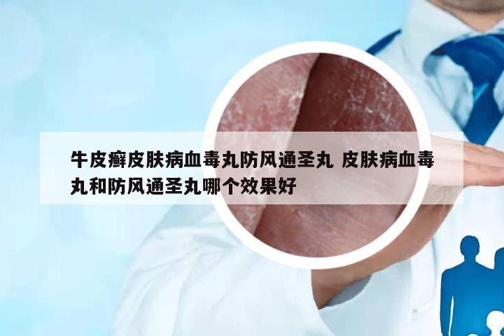 牛皮癬皮膚病血毒丸防風(fēng)通圣丸 皮膚病血毒丸和防風(fēng)通圣丸哪個(gè)效果好