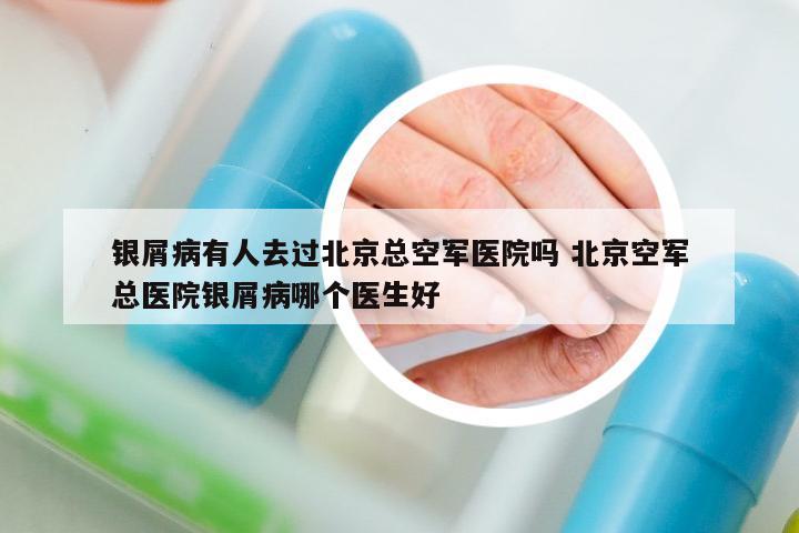 銀屑病有人去過北京總空軍醫(yī)院嗎 北京空軍總醫(yī)院銀屑病哪個醫(yī)生好