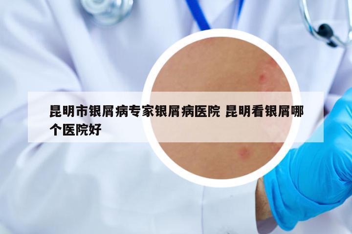 昆明市銀屑病專(zhuān)家銀屑病醫(yī)院 昆明看銀屑哪個(gè)醫(yī)院好