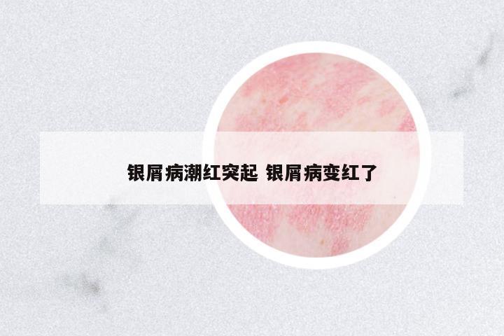 銀屑病潮紅突起 銀屑病變紅了