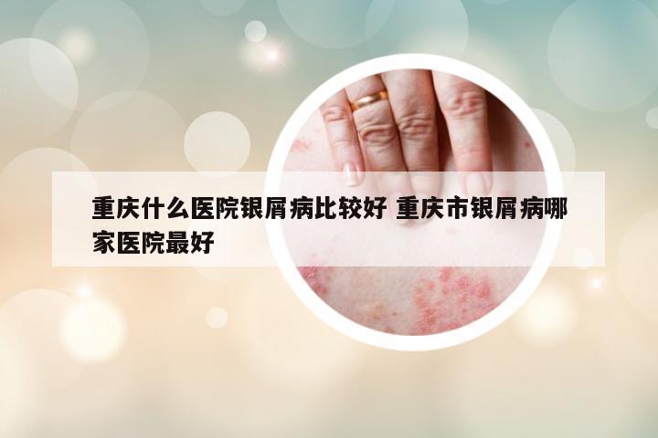 重慶什么醫(yī)院銀屑病比較好 重慶市銀屑病哪家醫(yī)院最好