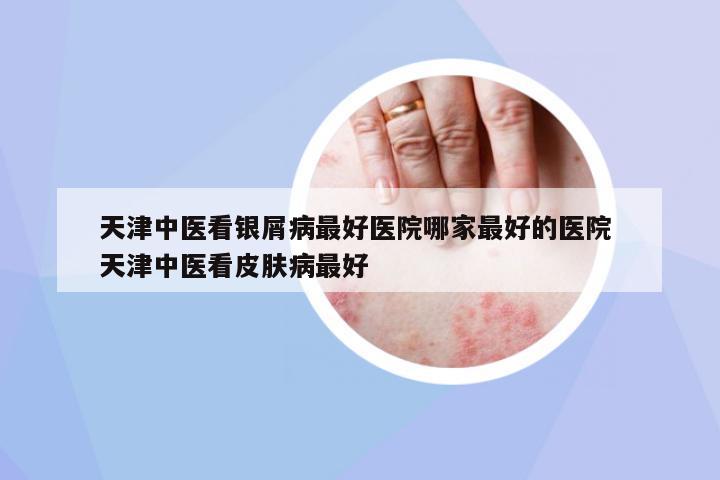 天津中醫(yī)看銀屑病最好醫(yī)院哪家最好的醫(yī)院 天津中醫(yī)看皮膚病最好