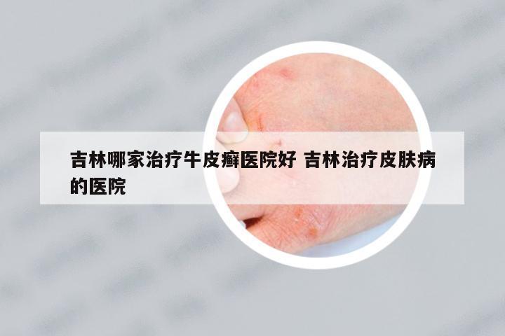 吉林哪家治療牛皮癬醫(yī)院好 吉林治療皮膚病的醫(yī)院