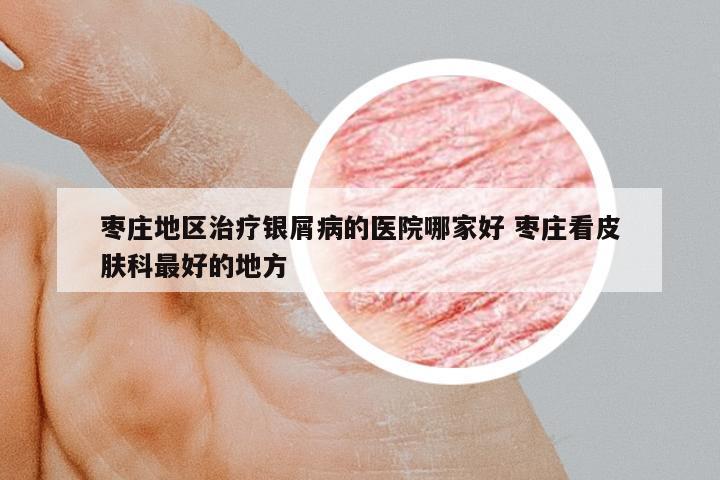 棗莊地區(qū)治療銀屑病的醫(yī)院哪家好 棗莊看皮膚科最好的地方