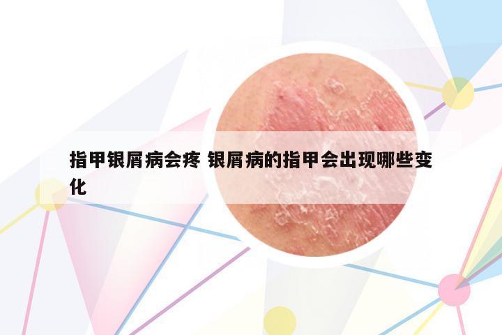 指甲銀屑病會(huì)疼 銀屑病的指甲會(huì)出現(xiàn)哪些變化
