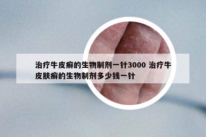 治療牛皮癬的生物制劑一針3000 治療牛皮膚癬的生物制劑多少錢(qián)一針