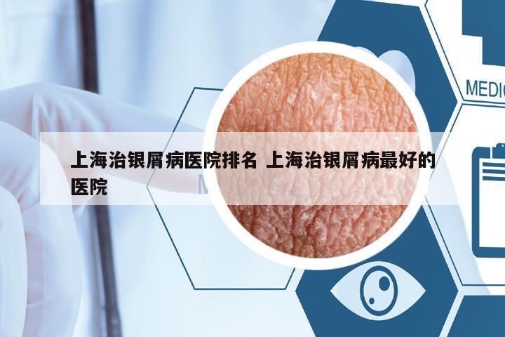 上海治銀屑病醫(yī)院排名 上海治銀屑病最好的醫(yī)院