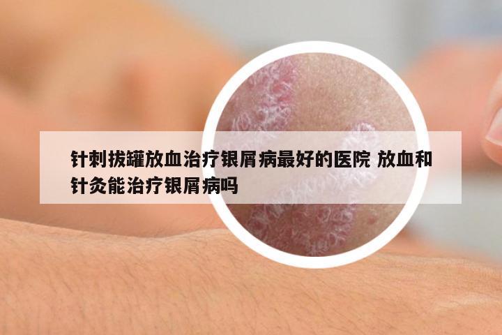 針刺拔罐放血治療銀屑病最好的醫(yī)院 放血和針灸能治療銀屑病嗎