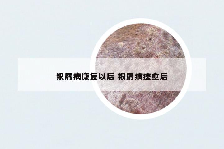 銀屑病康復(fù)以后 銀屑病痊愈后