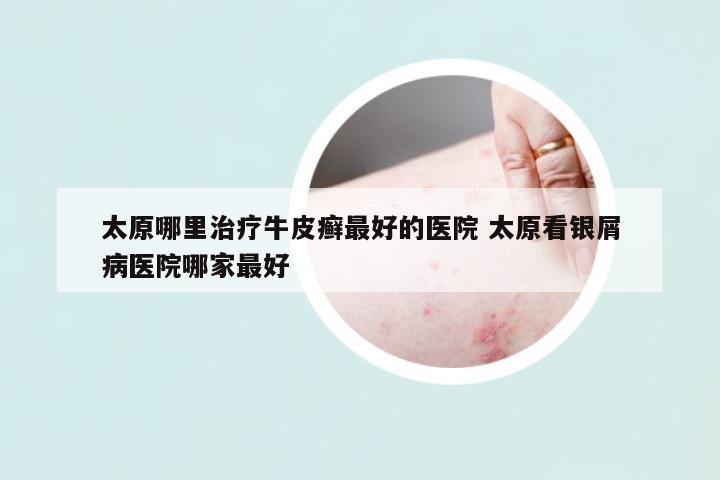 太原哪里治療牛皮癬最好的醫(yī)院 太原看銀屑病醫(yī)院哪家最好