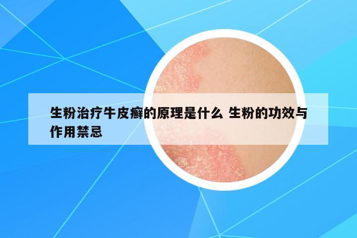 生粉治療牛皮癬的原理是什么 生粉的功效與作用禁忌