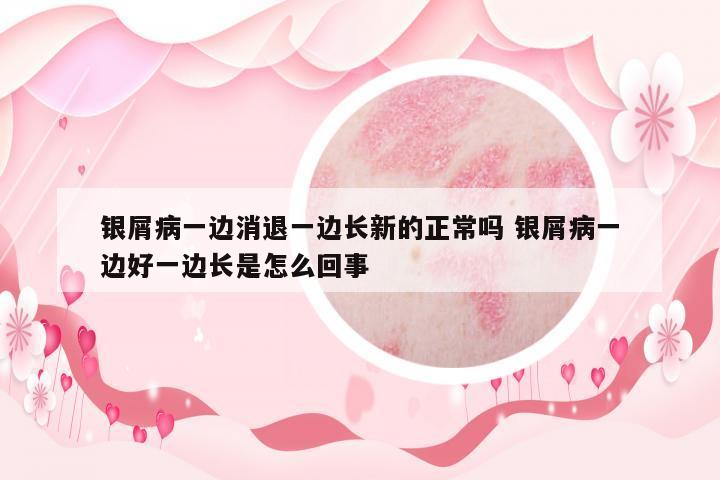 銀屑病一邊消退一邊長新的正常嗎 銀屑病一邊好一邊長是怎么回事