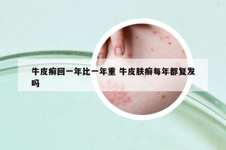 牛皮癬回一年比一年重 牛皮膚癬每年都復發(fā)嗎