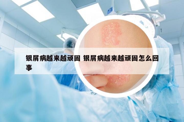 銀屑病越來越頑固 銀屑病越來越頑固怎么回事