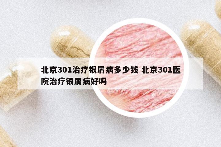 北京301治療銀屑病多少錢 北京301醫(yī)院治療銀屑病好嗎