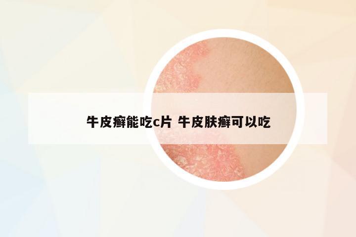 牛皮癬能吃c片 牛皮膚癬可以吃